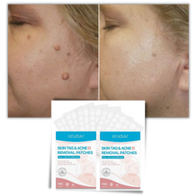 Carica l'immagine nel visualizzatore di Gallery, Cerotto per il trattamento di rimozione delle escrescenze della pelle - Ozerty
