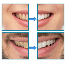 Carica l'immagine nel visualizzatore di Gallery, Sbiancamento rapido dei denti - Ozerty

